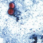 Michigan Reports First Deaths in Major Cyclosporiasis Outbreak as Thousands Fall Ill Across US