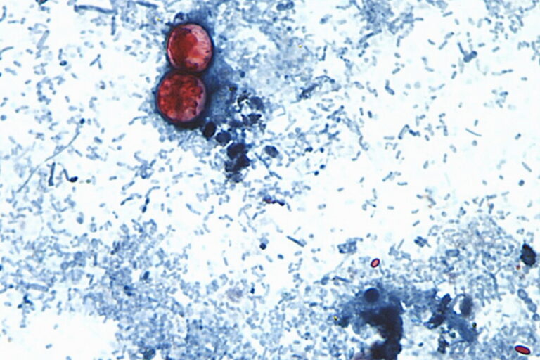 Michigan Reports First Deaths in Major Cyclosporiasis Outbreak as Thousands Fall Ill Across US